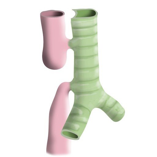 Tracheoesophageal Fistula