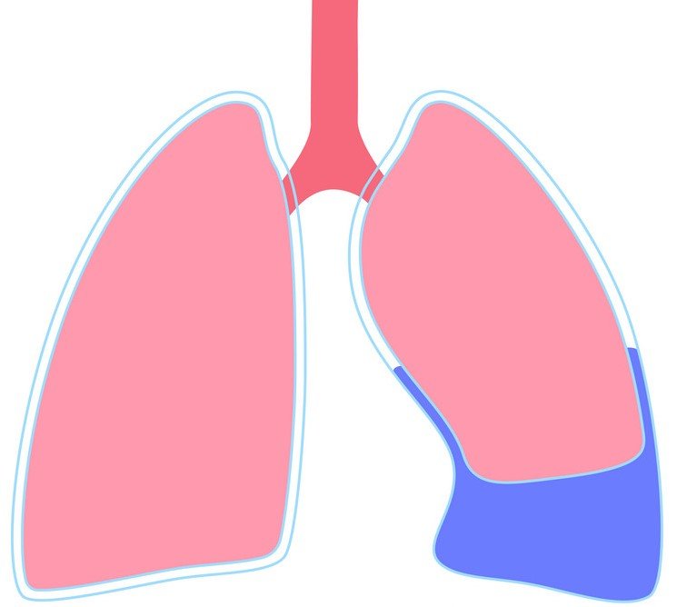 Pleural Effusion