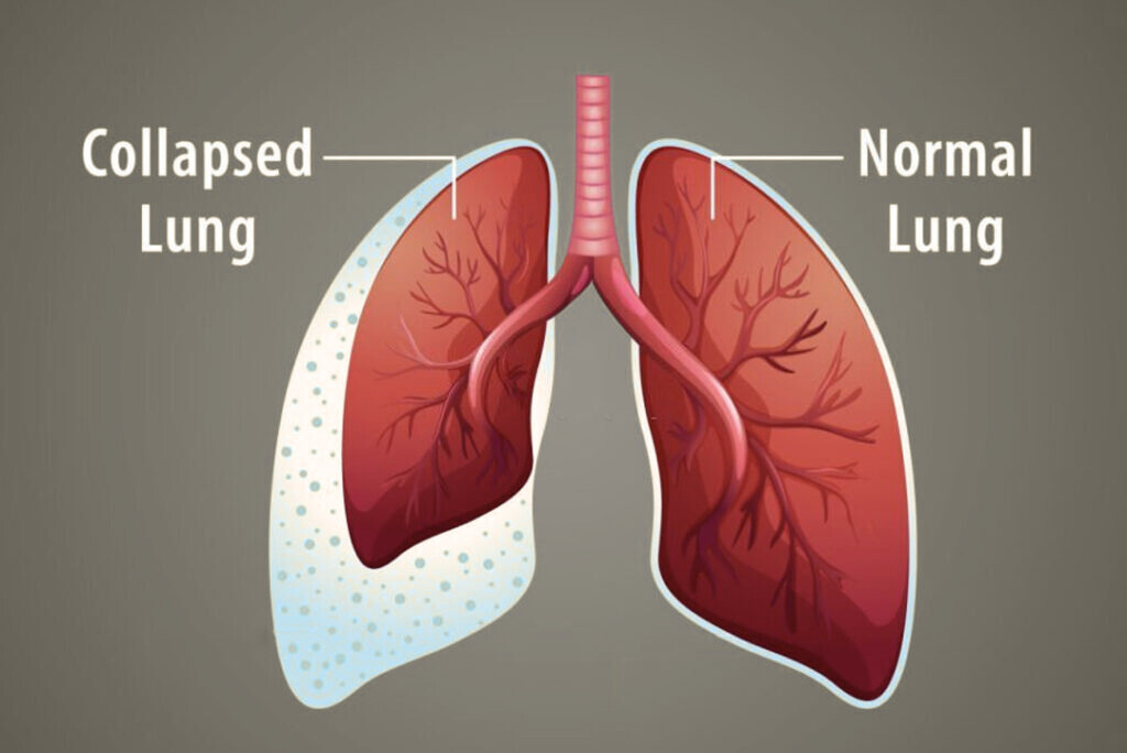 Pneumothorax